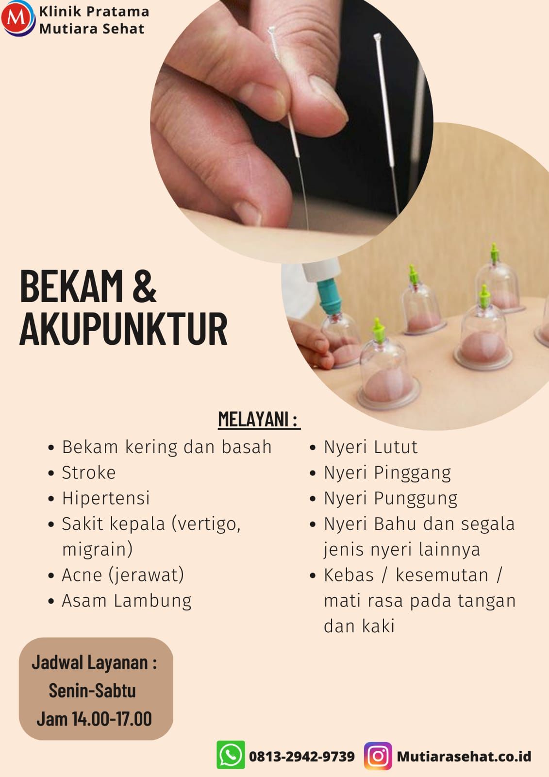 akupuncture